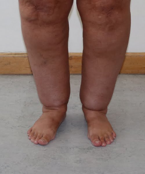 Cankles surgery before AP view