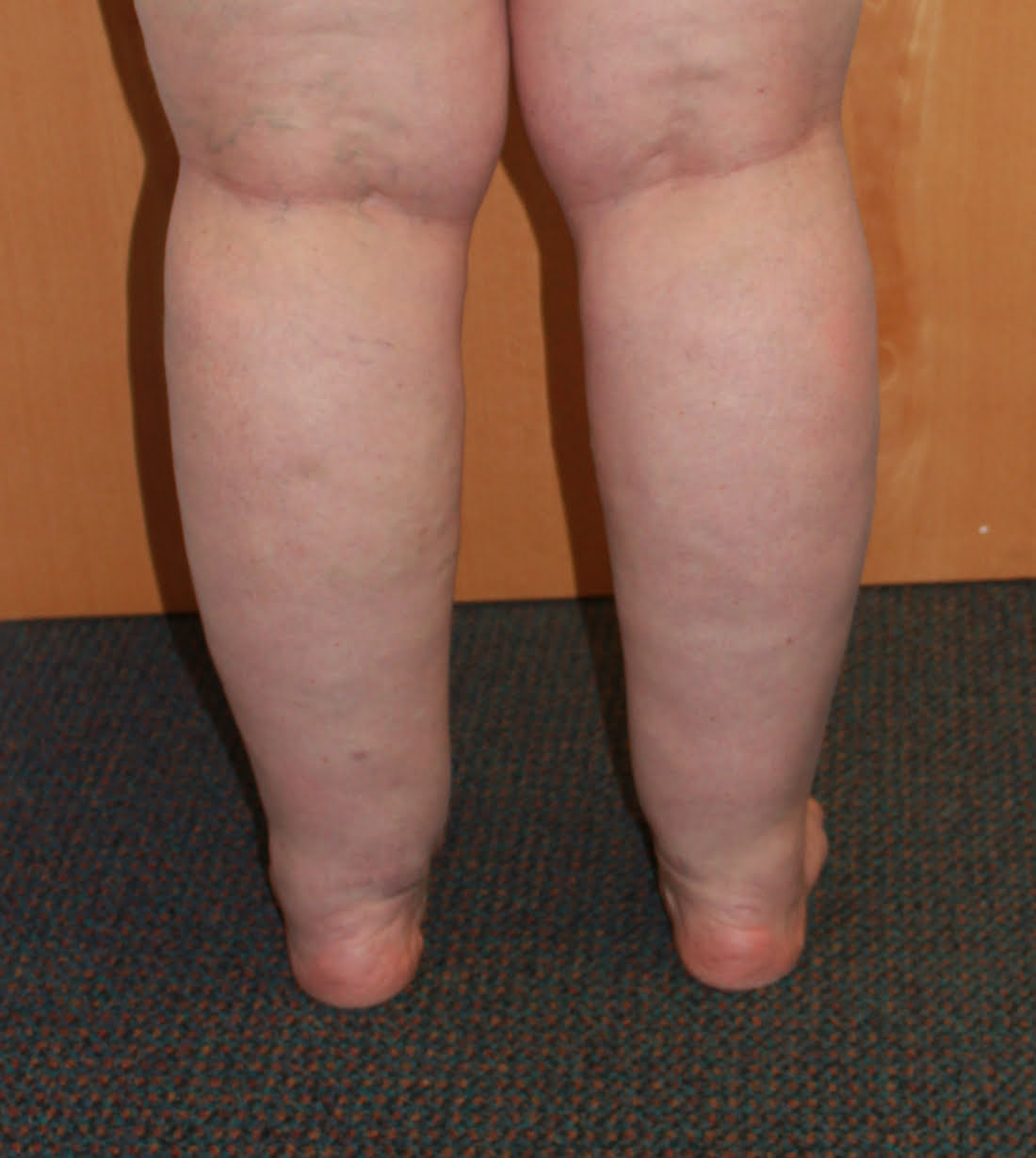 Cankles surgery before posterior view