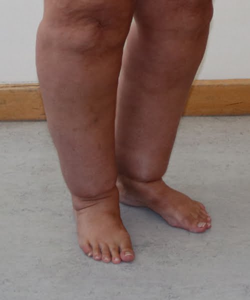 Cankles surgery before right oblique