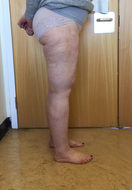 Lipoedema liposuction after right lateral