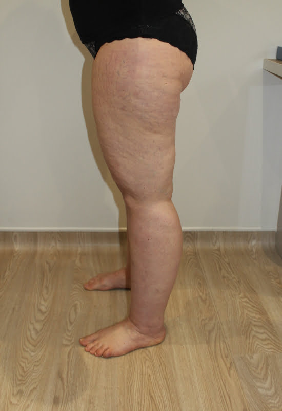 Lipoedema liposuction before left lateral