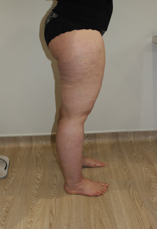 Lipoedema liposuction before right lateral