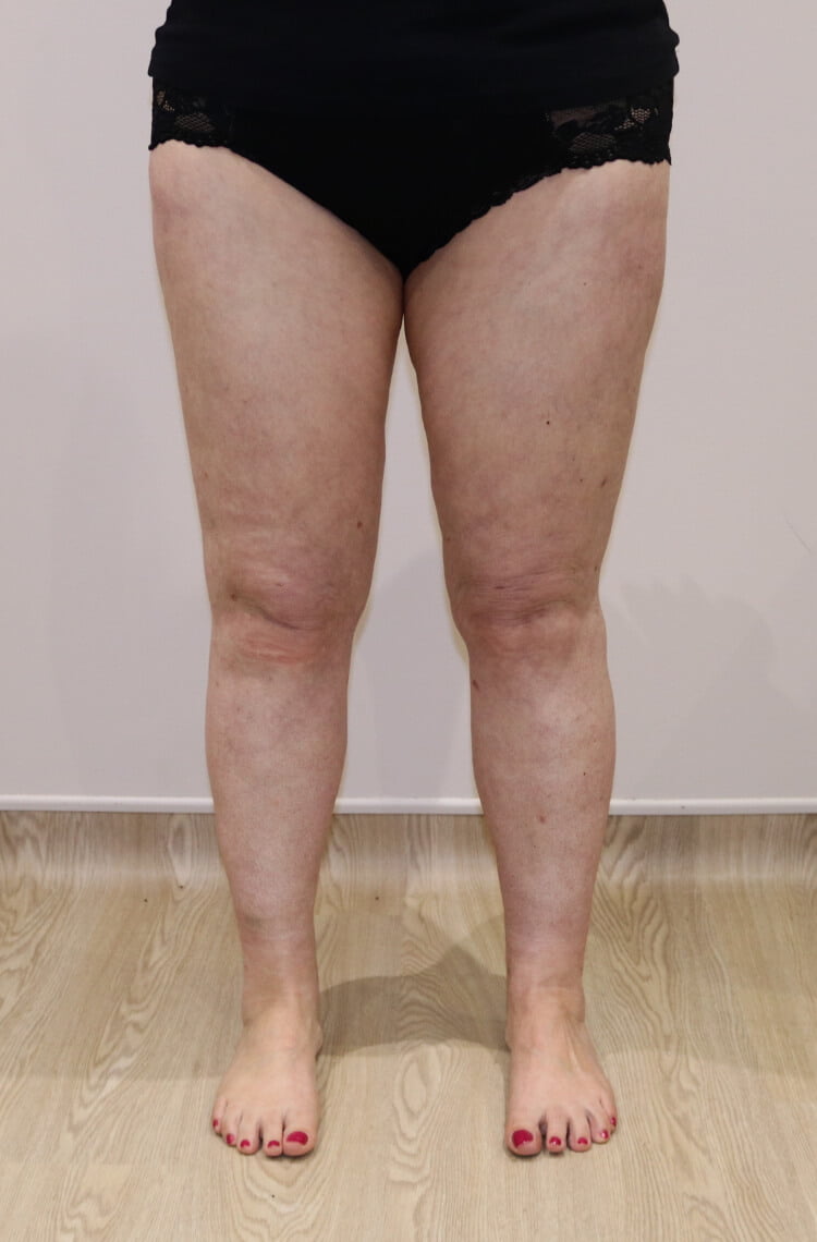 Lower limb lipoedema liposuction after AP view