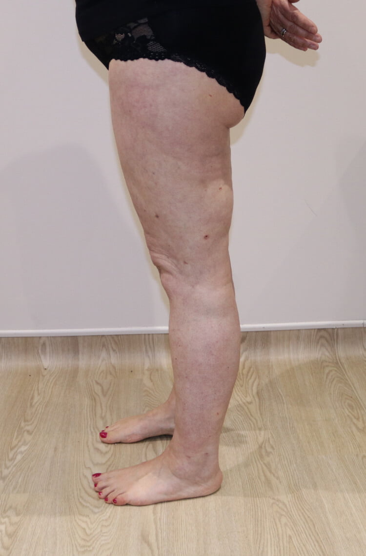 Lower limb lipoedema liposuction after left lateral