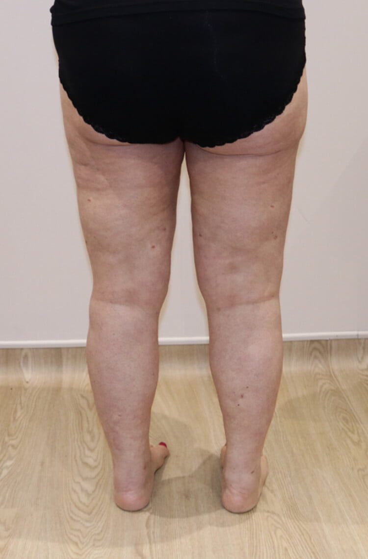 Lower limb lipoedema liposuction after posterior view