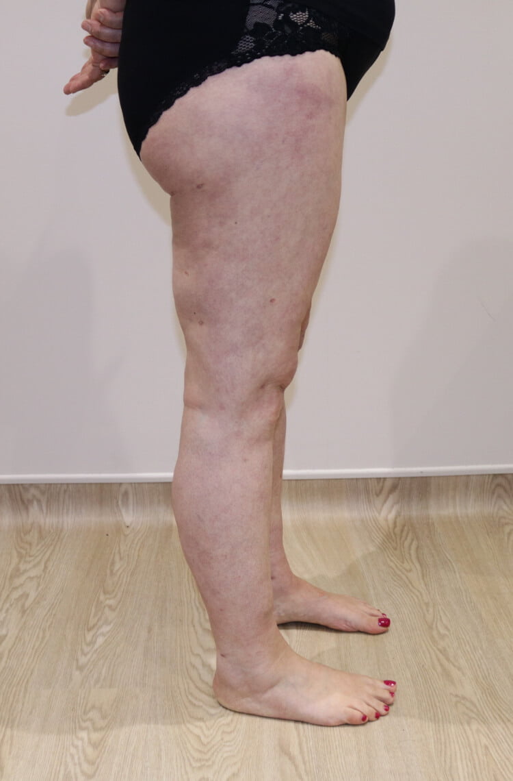 Lower limb lipoedema liposuction after right lateral