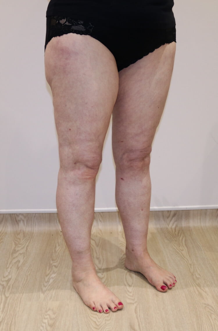 Lower limb lipoedema liposuction after right oblique