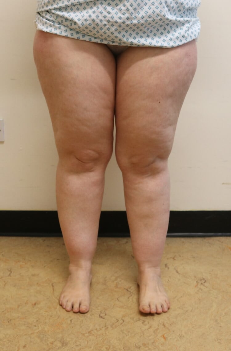 Lower limb lipoedema liposuction before AP view