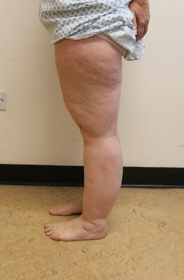 Lower limb lipoedema liposuction before left lateral