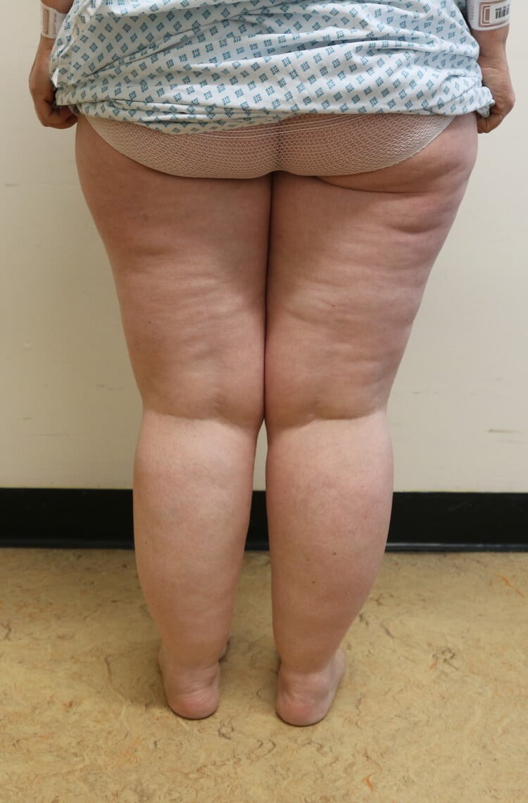 Lower limb lipoedema liposuction before posterior view