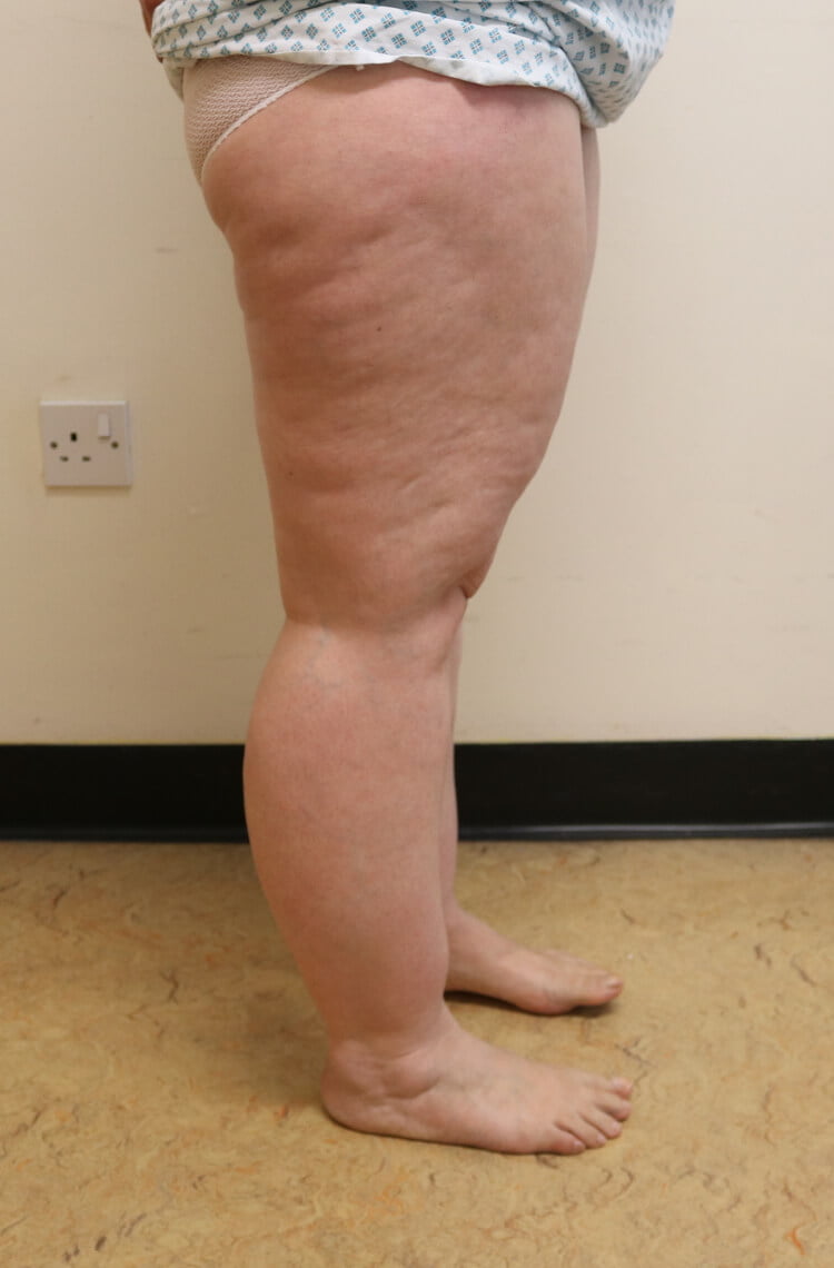 Lower limb lipoedema liposuction before right lateral