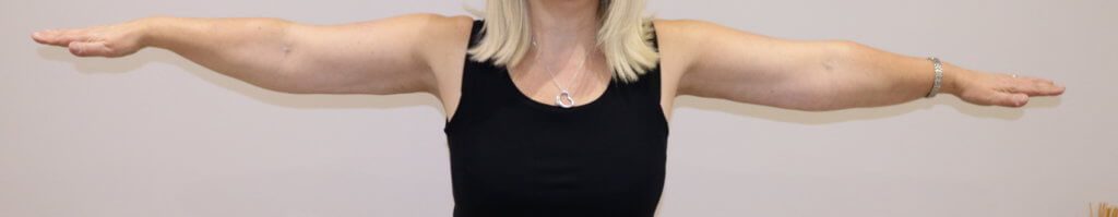 Upper limb lipoedema after liposuction