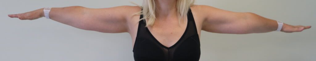 Upper limb lipoedema before liposuction