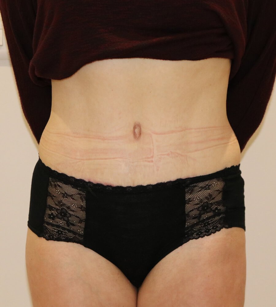 Abdominoplasty tummy tuck after AP view