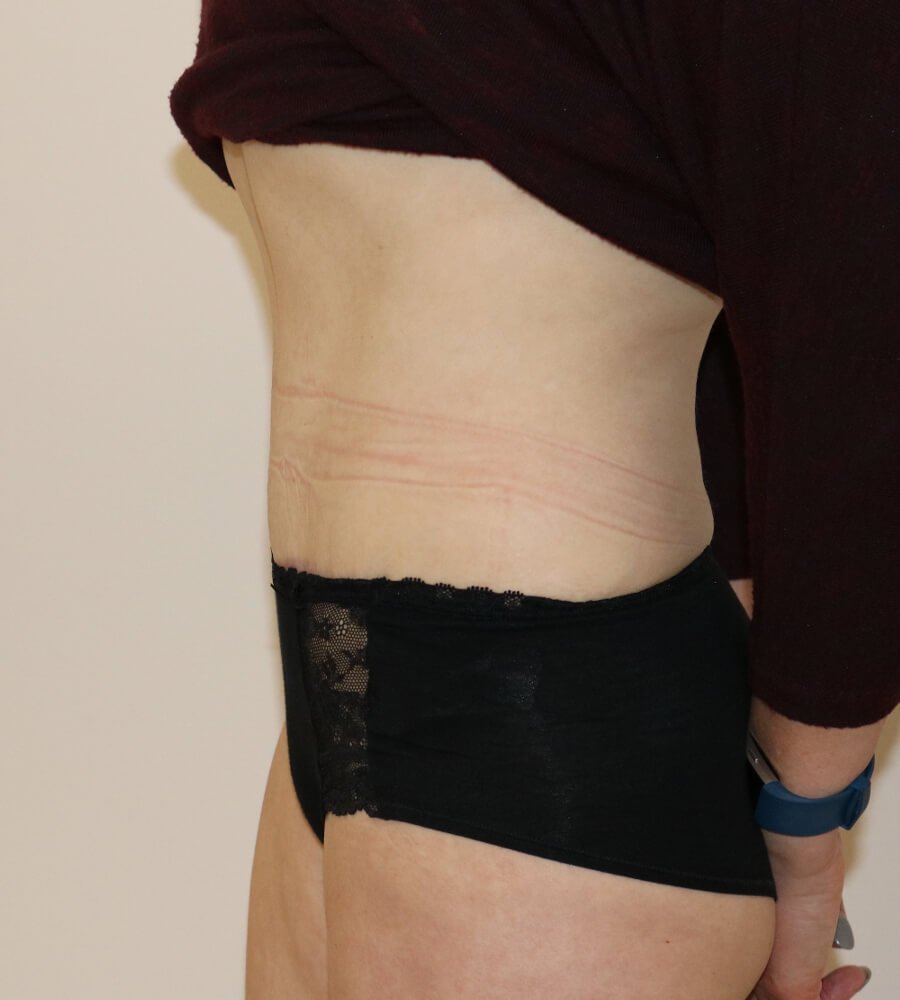 Abdominoplasty tummy tuck after left lateral