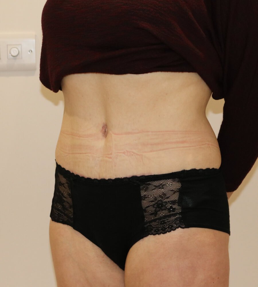 Abdominoplasty tummy tuck after left oblique