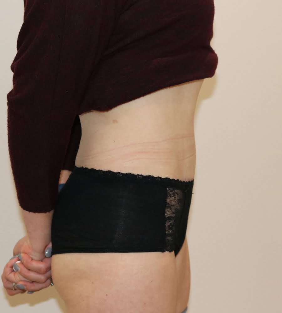 Abdominoplasty tummy tuck after right lateral