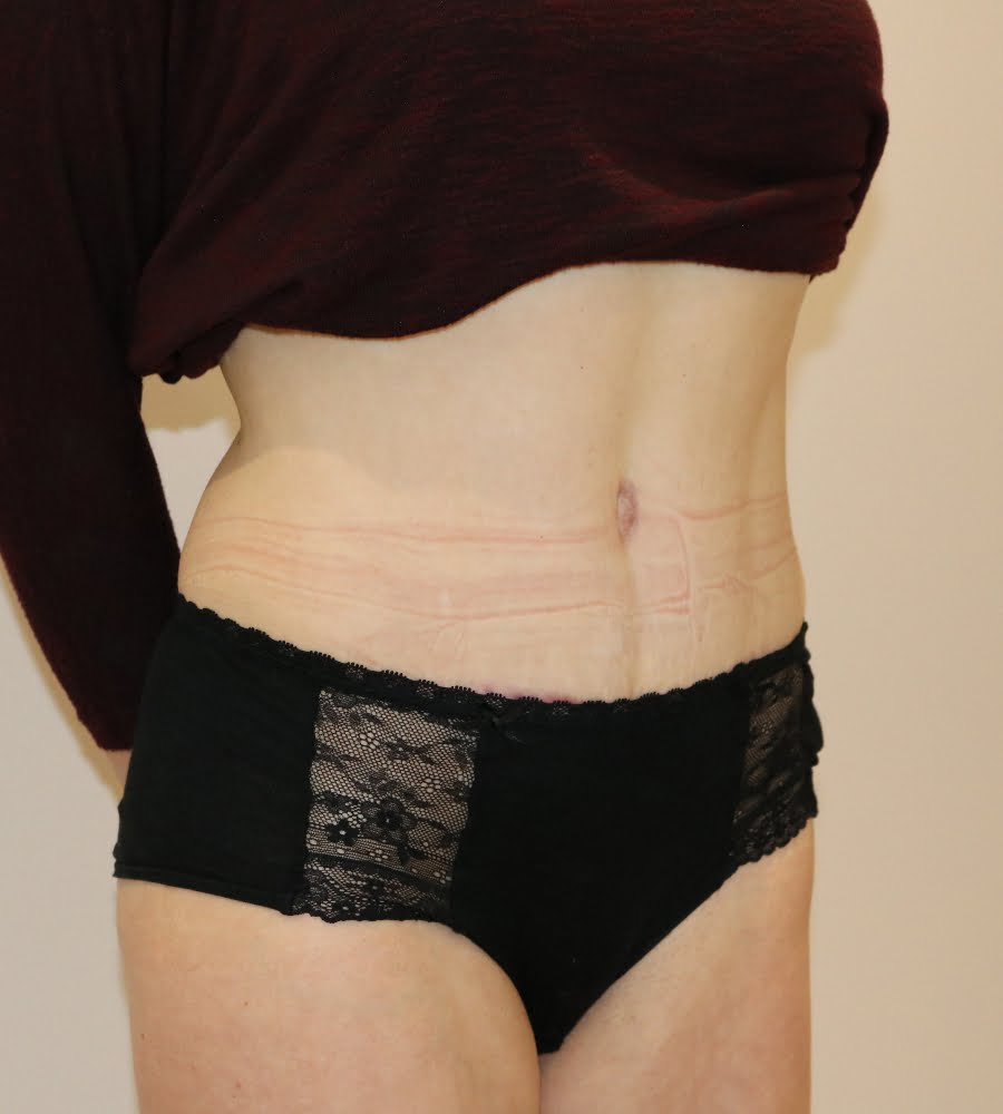 Abdominoplasty tummy tuck after right oblique