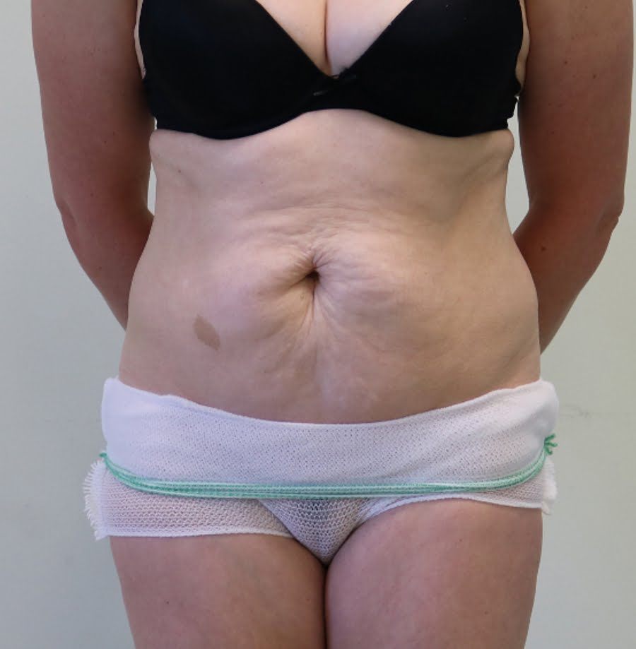Abdominoplasty tummy tuck before AP view