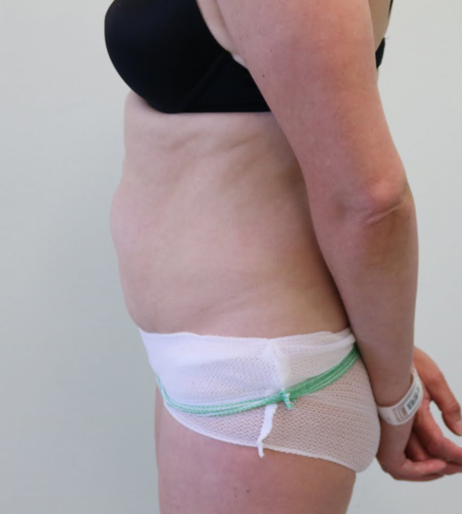 Abdominoplasty tummy tuck before left lateral