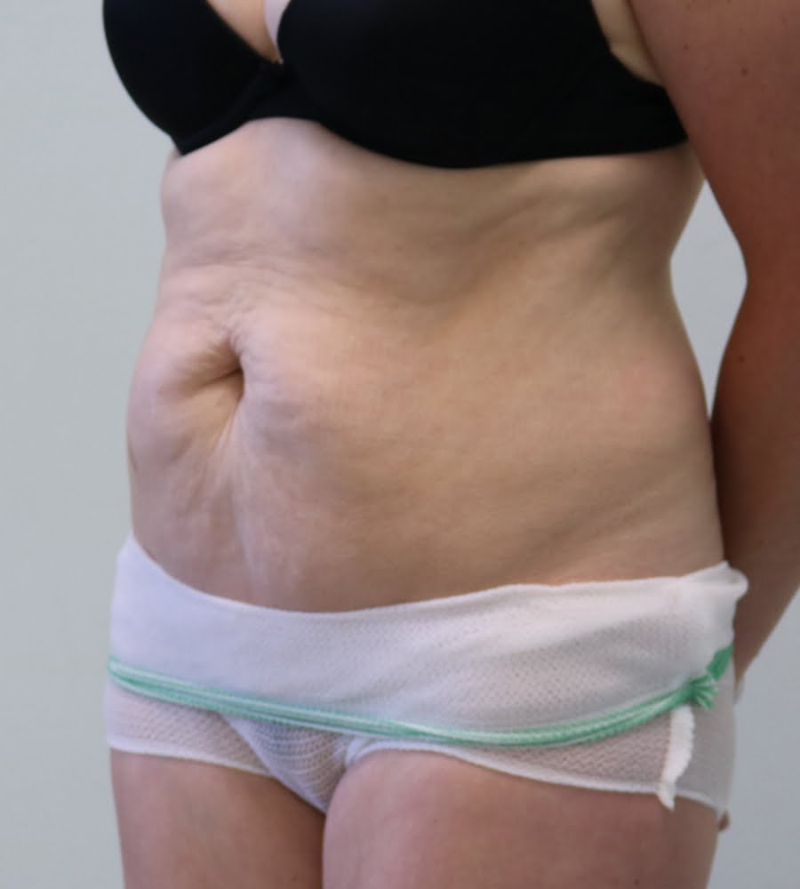 Abdominoplasty tummy tuck before left oblique