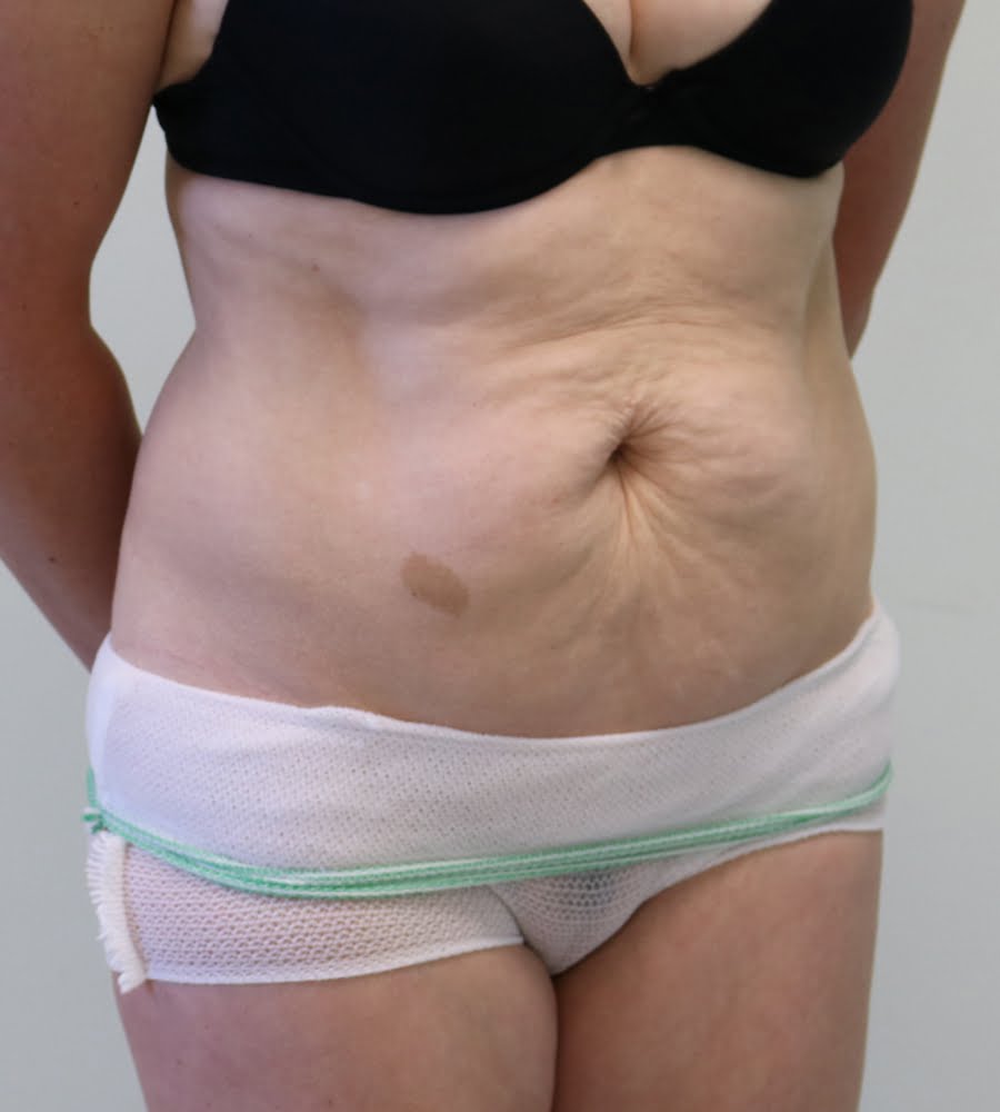 Abdominoplasty tummy tuck before right oblique