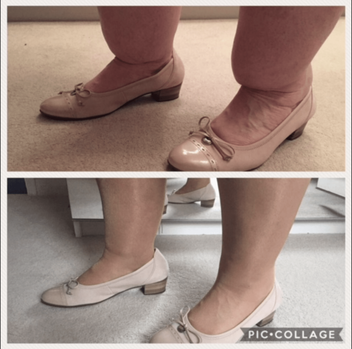 Cankles before and after surgery
