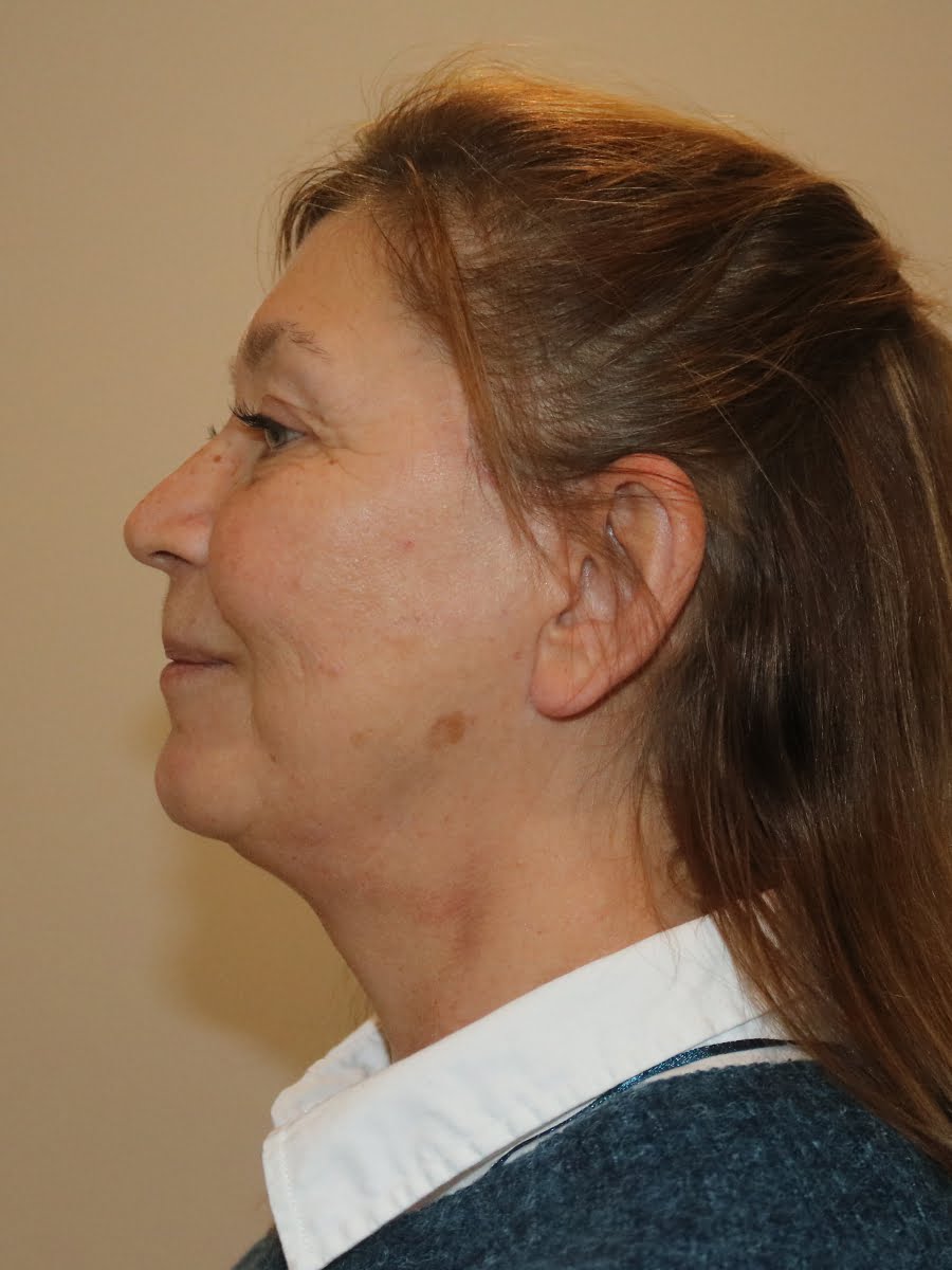 Facelift necklift after surgery left lateral
