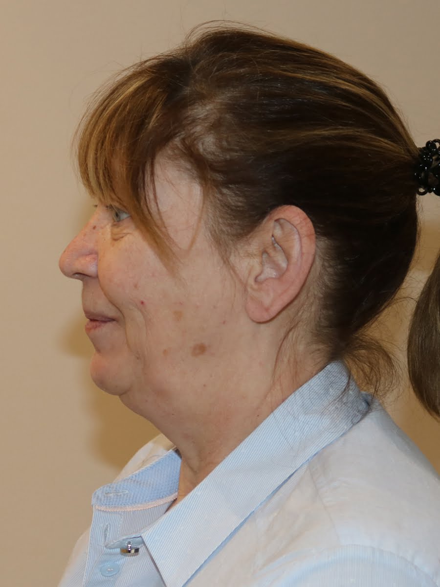 Facelift necklift before surgery left lateral