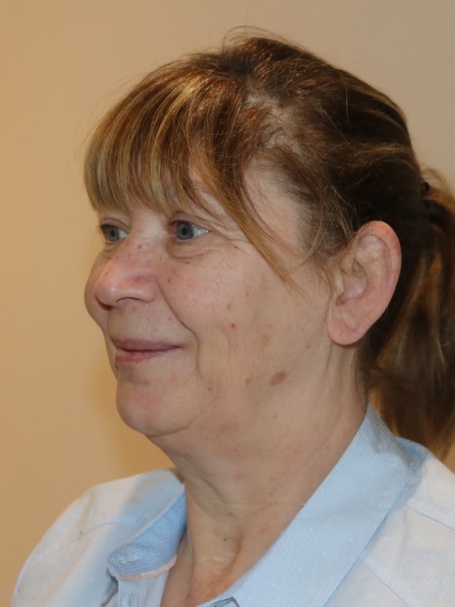 Facelift necklift before surgery left oblique