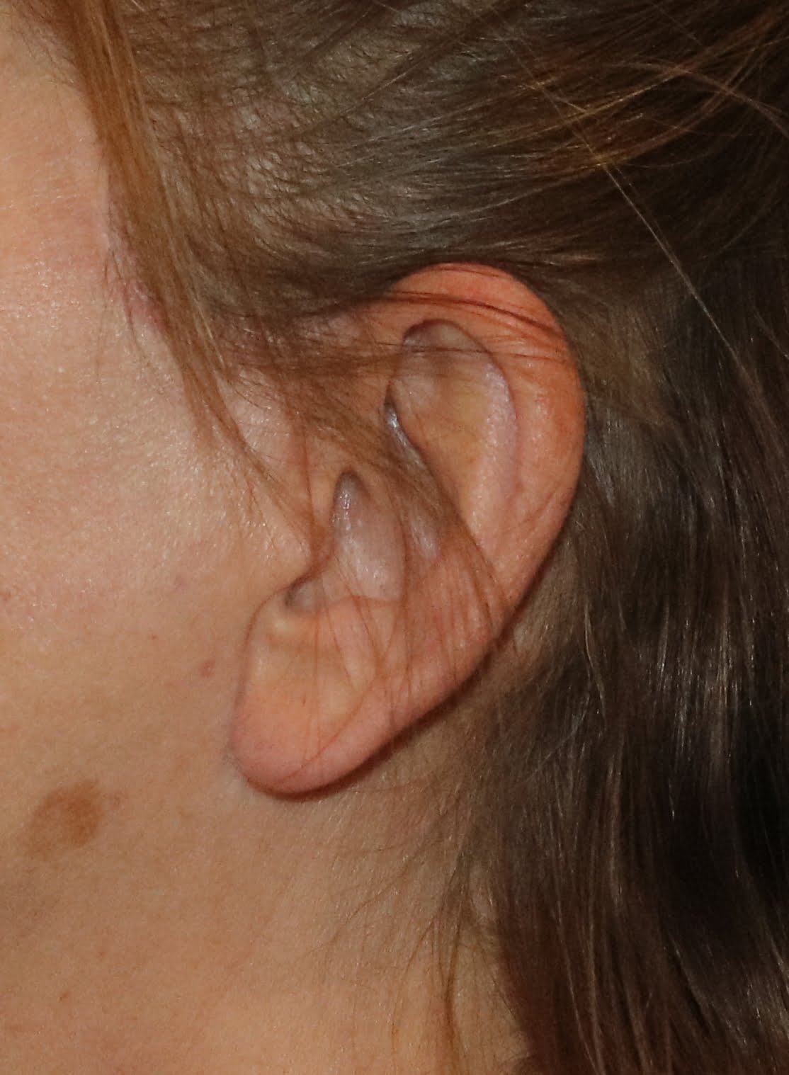 Facelift scar