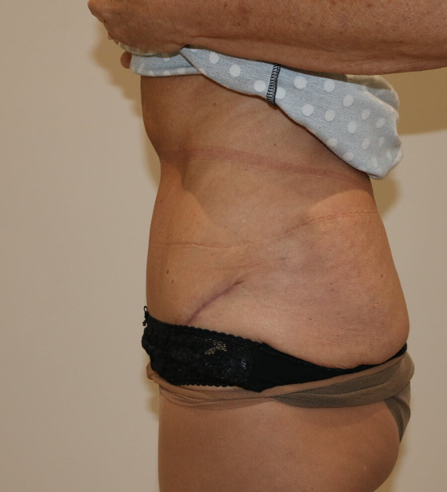 High lateral tension tummy tuck after left lateral 1