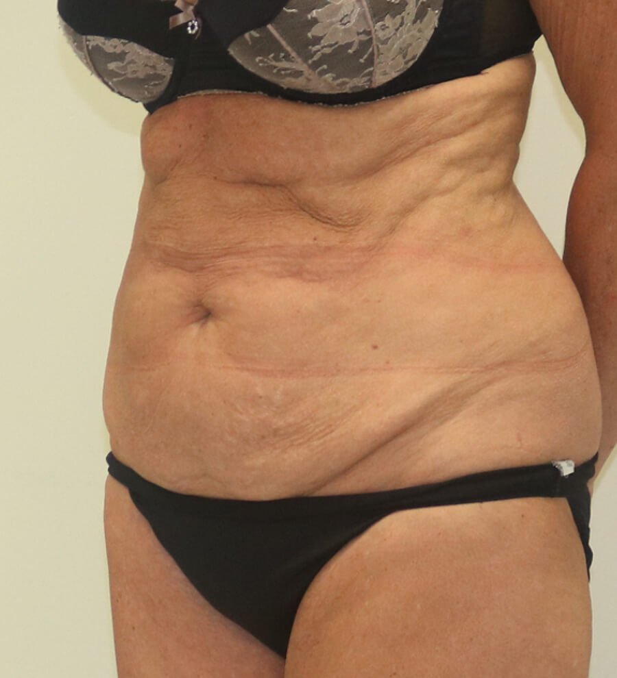 High lateral tension tummy tuck before left oblique 2