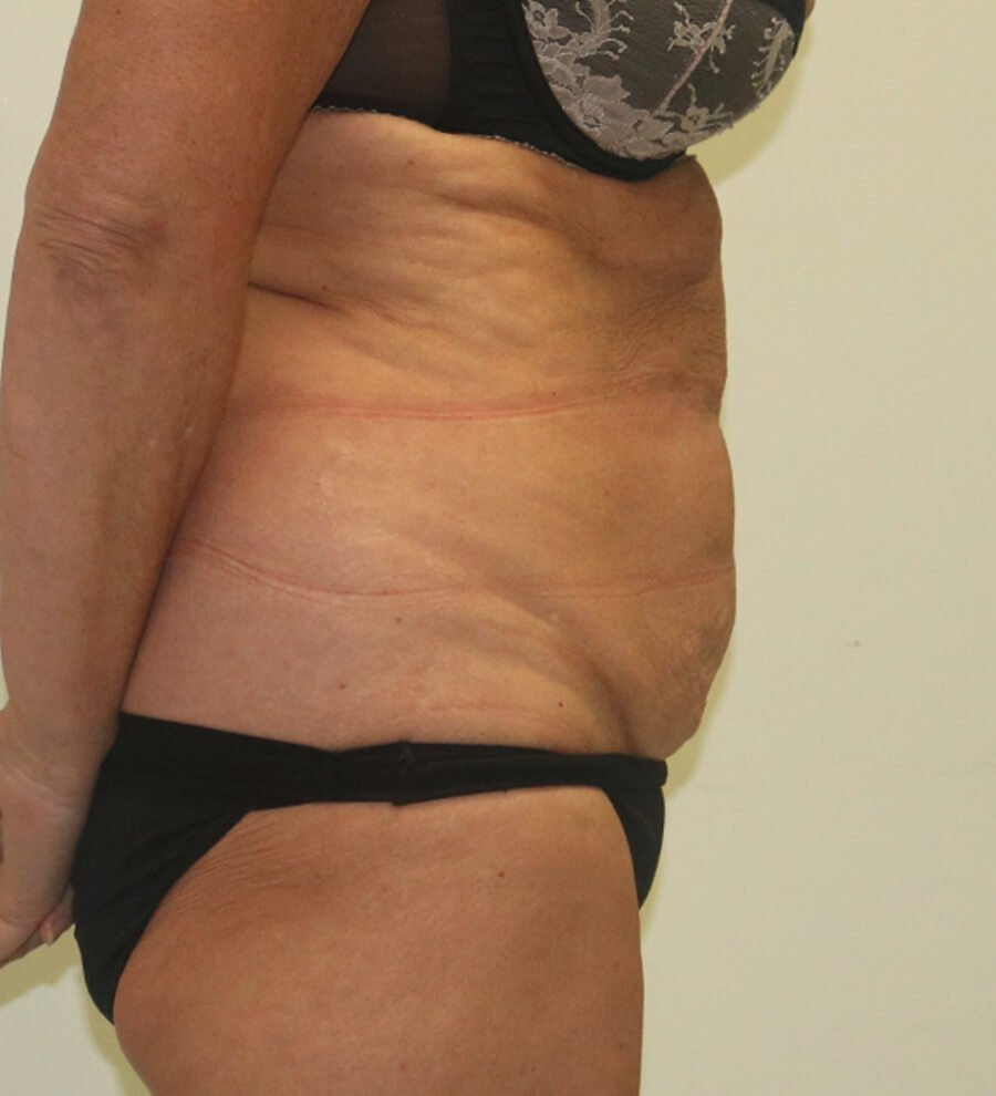 High lateral tension tummy tuck before right lateral 2