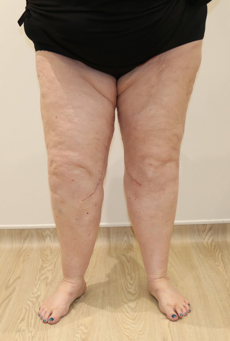 Lower limb lipoedema liposuction after surgery AP view 2