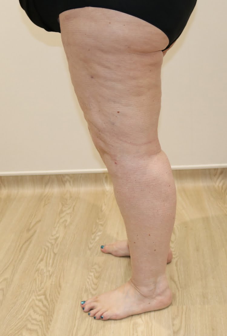 Lower limb lipoedema liposuction after surgery left lateral 2