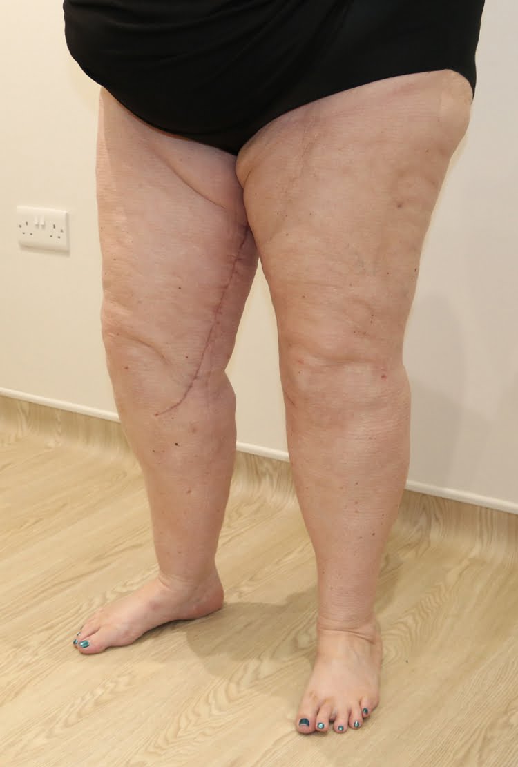 Lower limb lipoedema liposuction after surgery left oblique 2