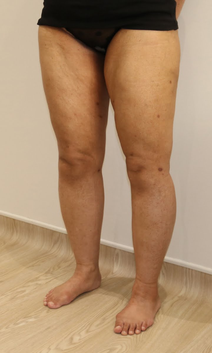 Lower limb lipoedema liposuction after surgery left oblique