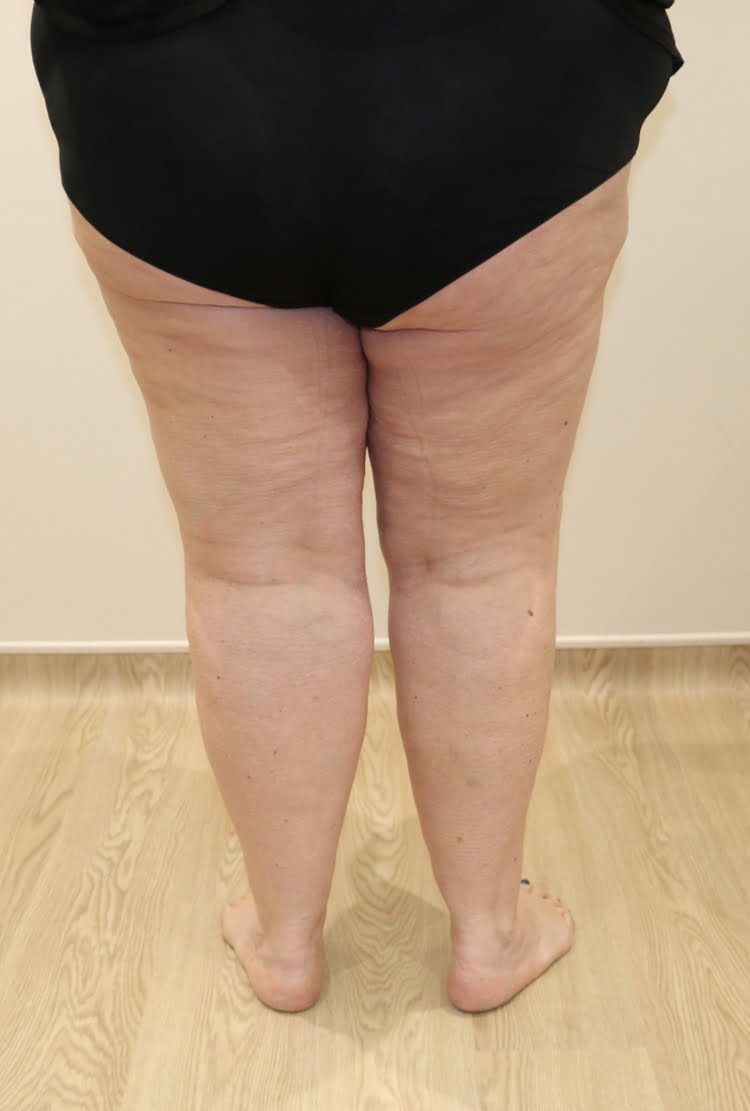 Lower limb lipoedema liposuction after surgery posterior view 2