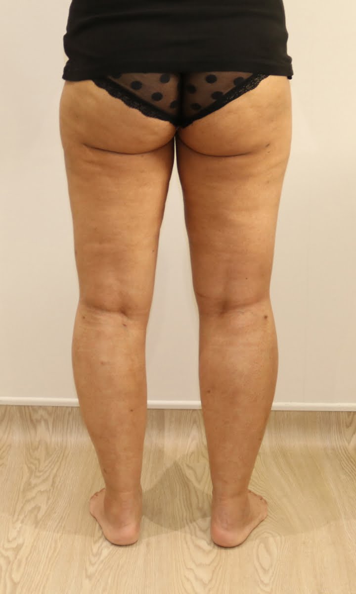 Lower limb lipoedema liposuction after surgery posterior view