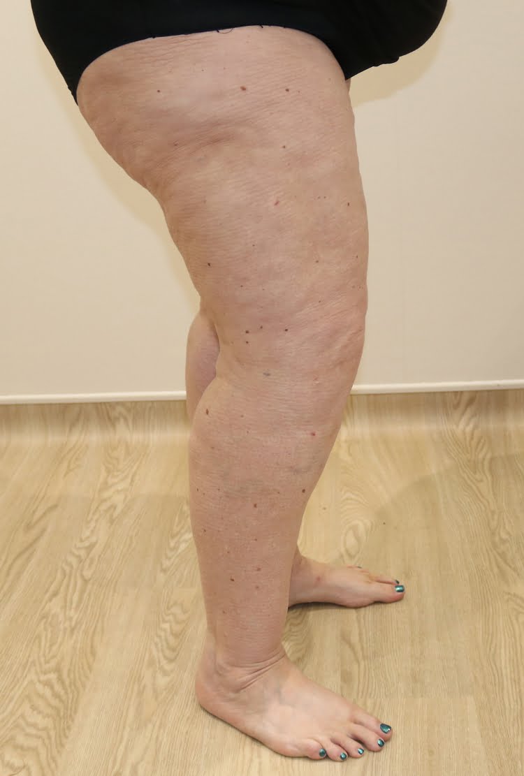 Lower limb lipoedema liposuction after surgery right lateral 2