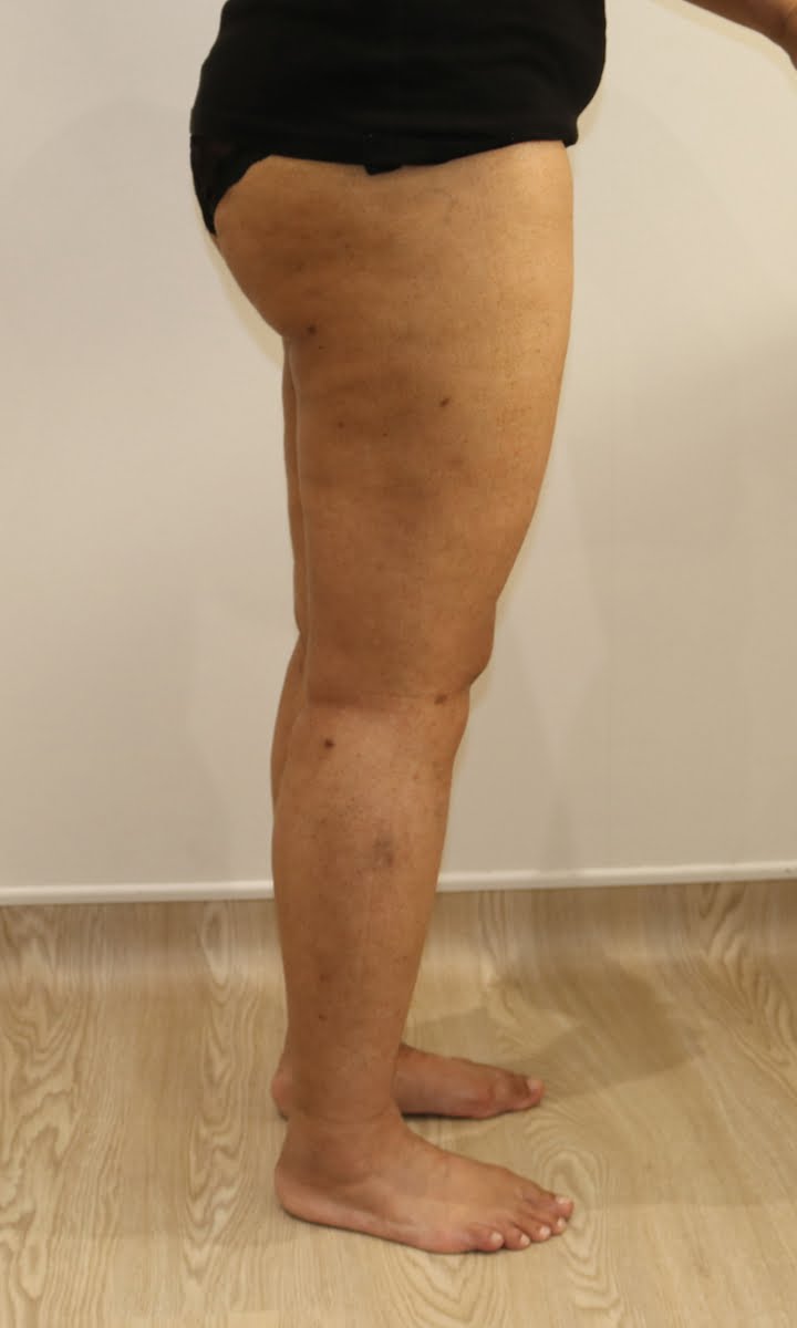 Lower limb lipoedema liposuction after surgery right lateral