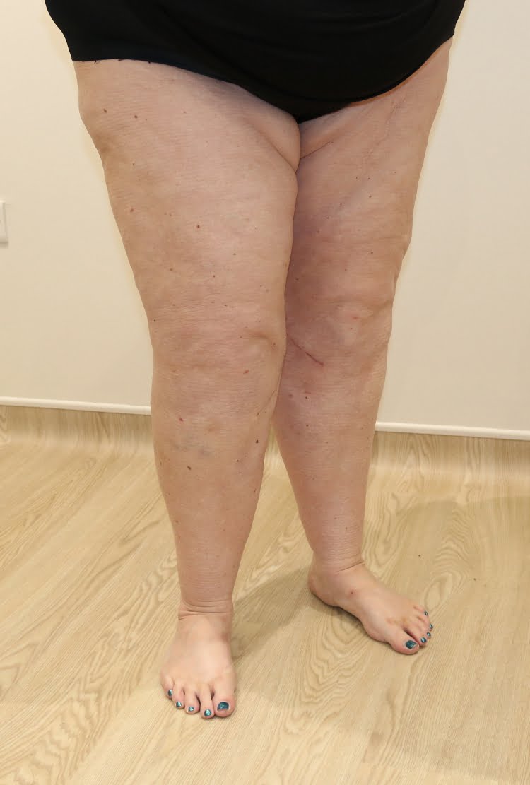 Lower limb lipoedema liposuction after surgery right oblique 2