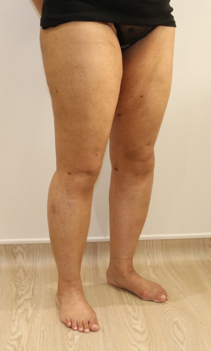 Lower limb lipoedema liposuction after surgery right oblique