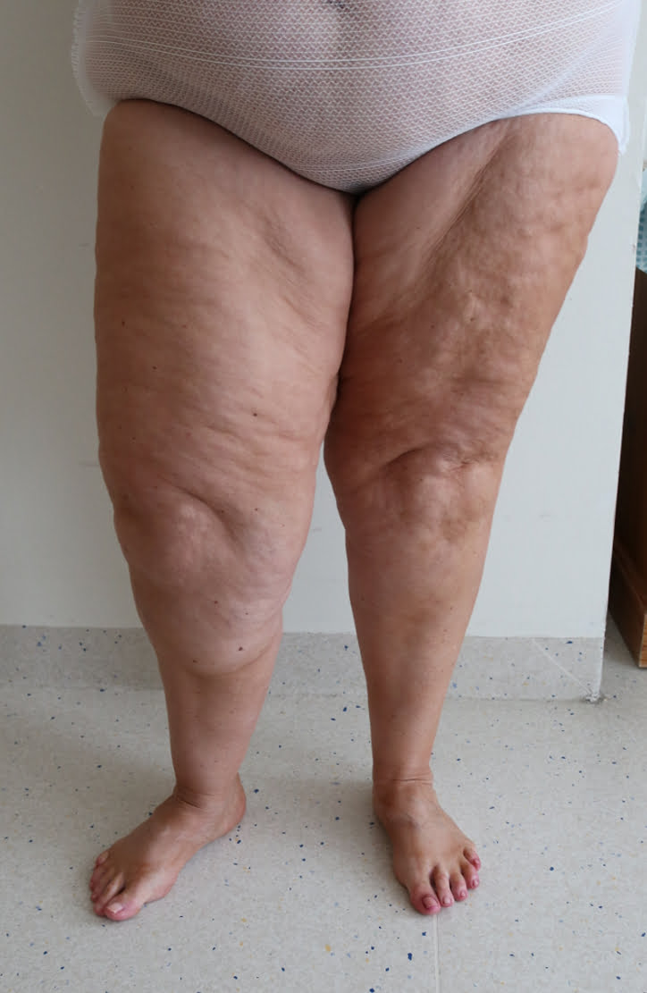 Lower limb lipoedema liposuction before surgery AP view 3