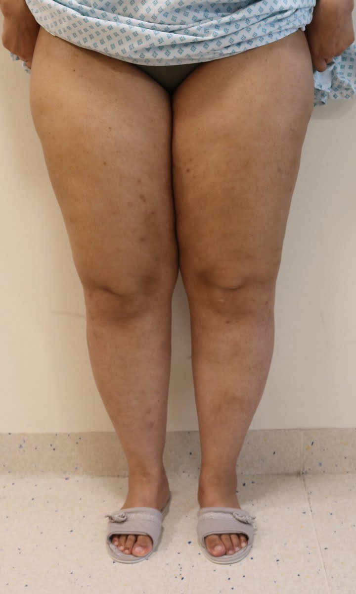 Lower limb lipoedema liposuction before surgery AP view
