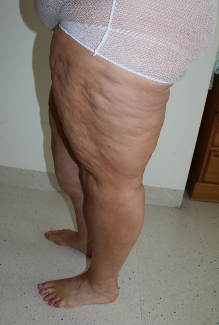 Lower limb lipoedema liposuction before surgery left lateral 2