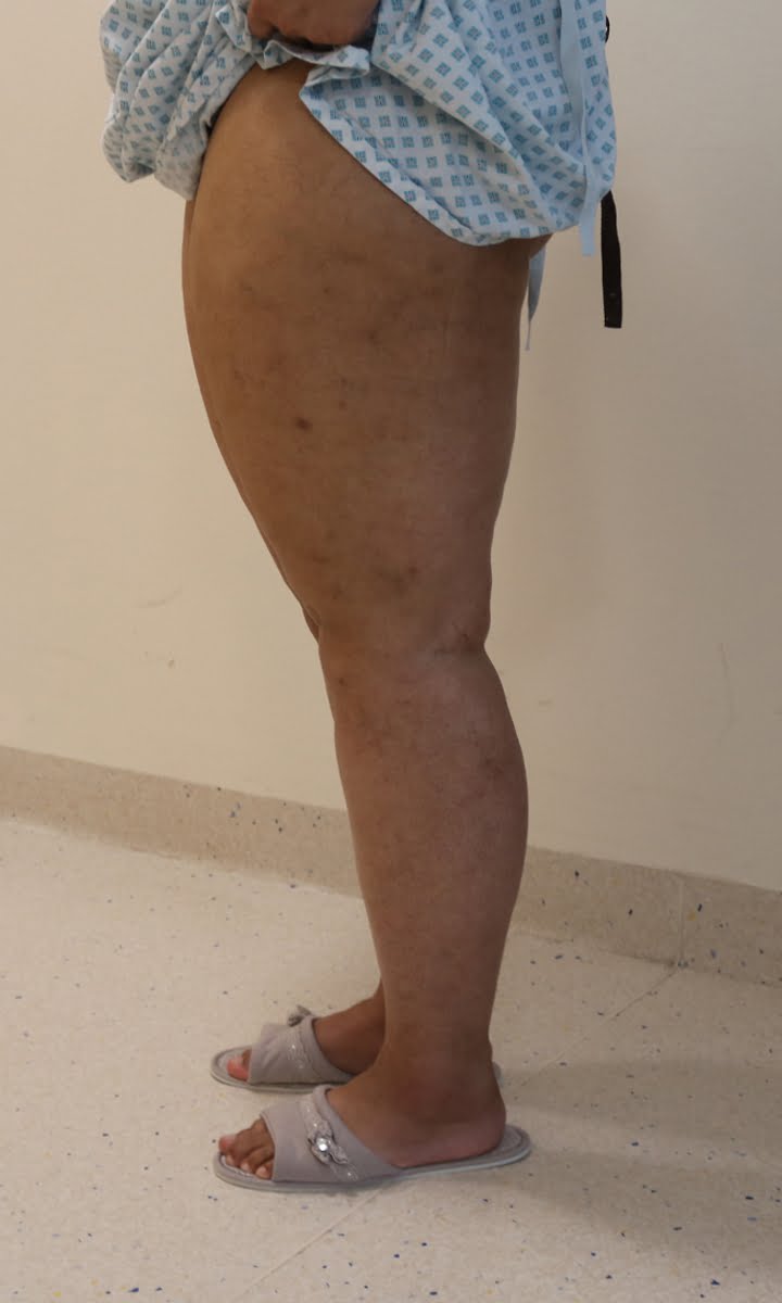 Lower limb lipoedema liposuction before surgery left lateral