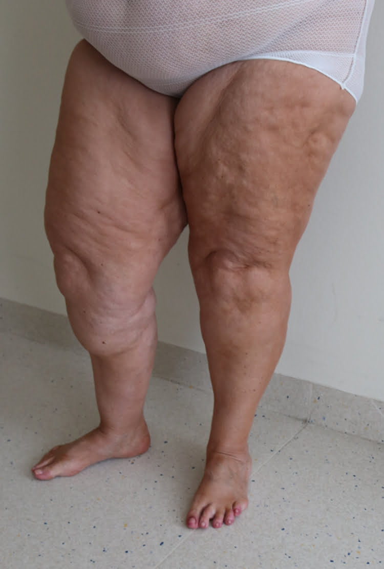 Lower limb lipoedema liposuction before surgery left oblique 2