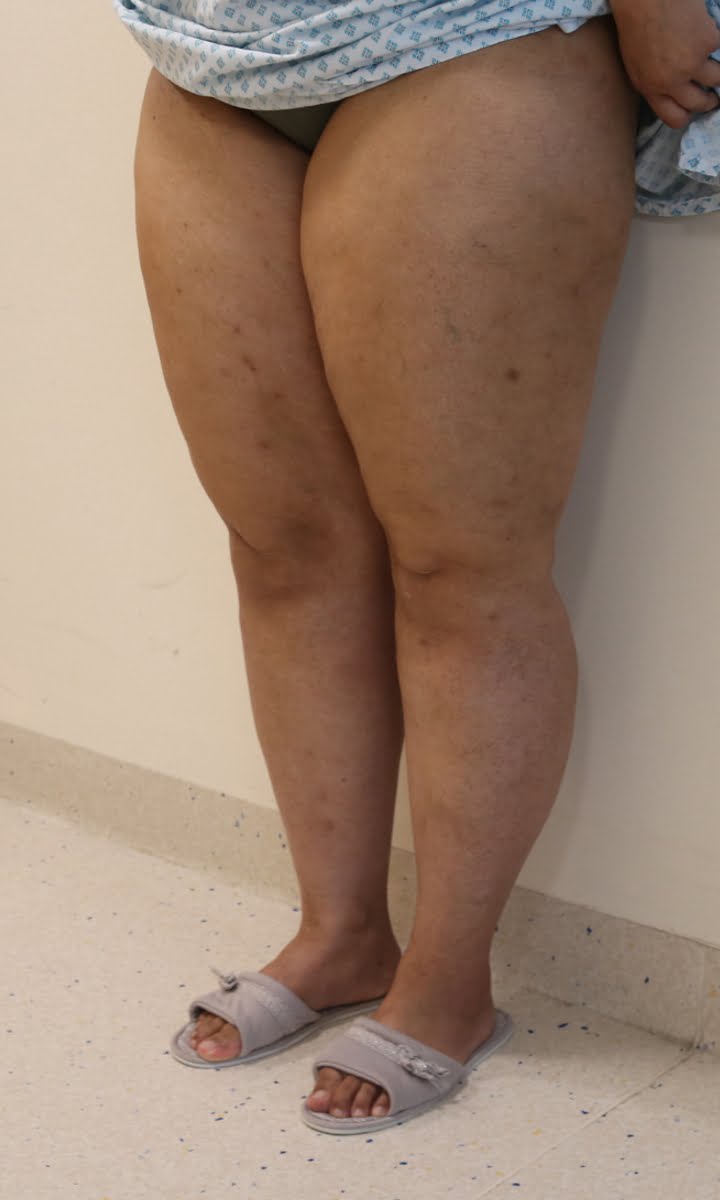 Lower limb lipoedema liposuction before surgery left oblique